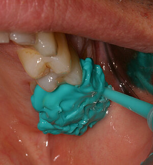 Schritt 6: Umspritzen der Zähne